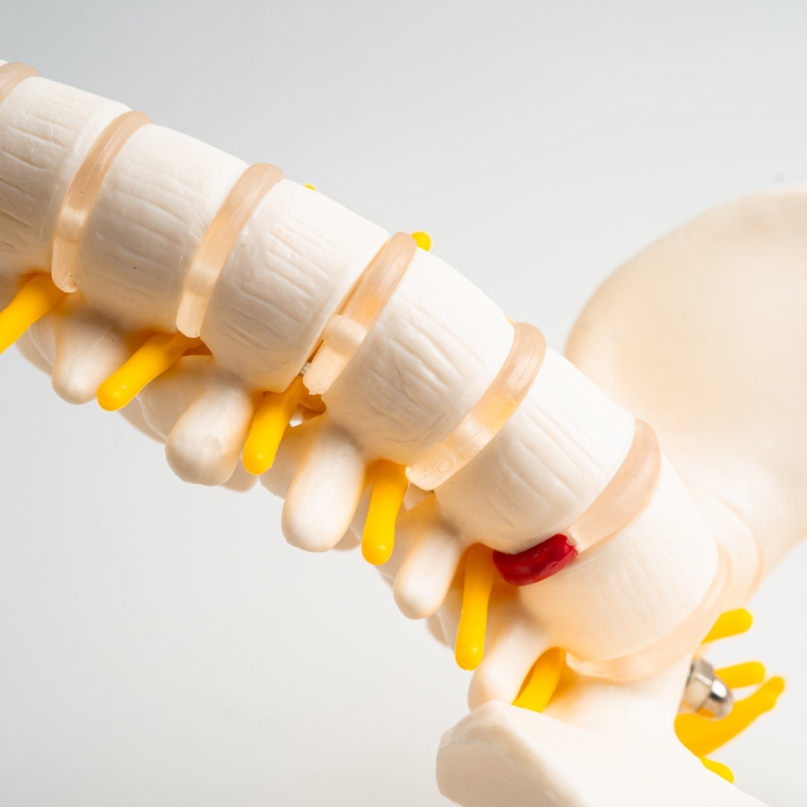 Herniated Disc Chiropractor in Charleston, SC - Axis Chiropractic Care